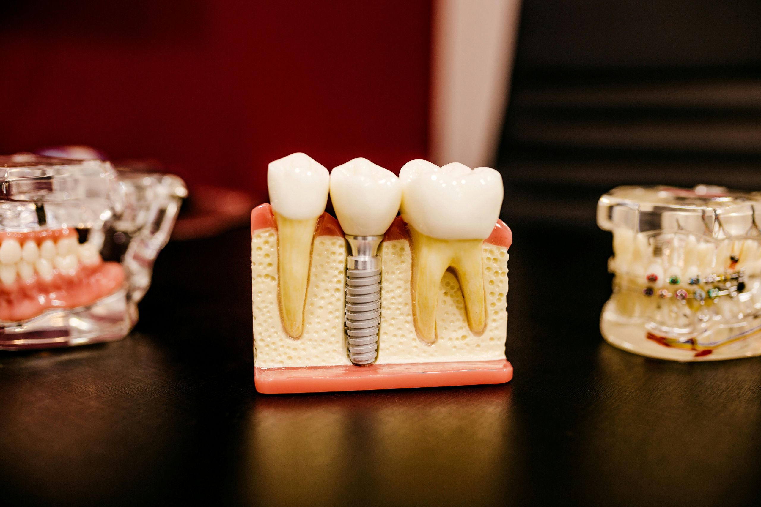 A dental model showing a dental implant between two natural teeth, with jawbone structure and gums, and two other dental models with braces in the background, illustrates dental procedures—such as how long does a root canal take—on a dark surface.