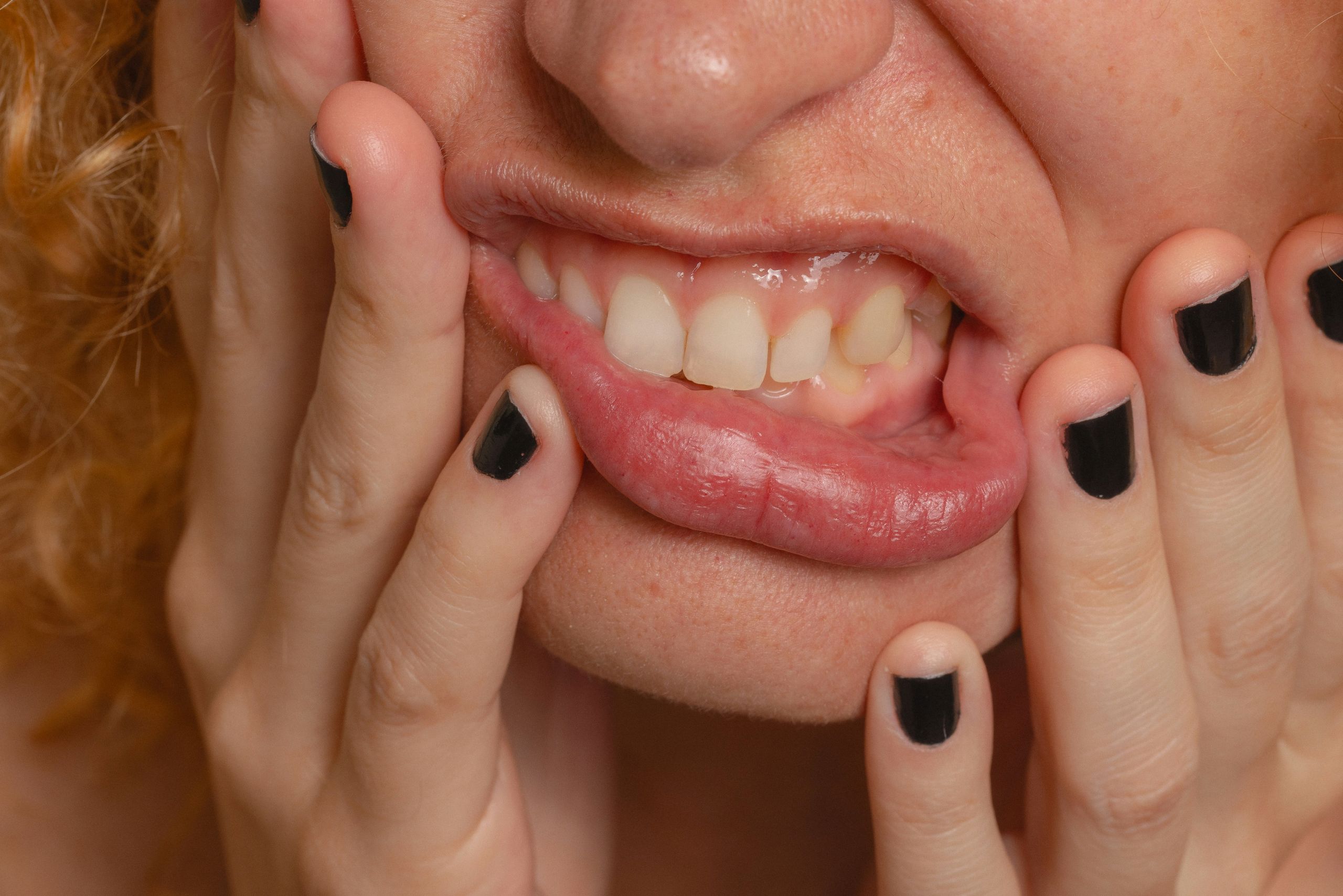 A close-up of a person's mouth as they lift their upper lip to reveal their teeth and gums, highlighting the tooth trauma she is getting. Their hands, with black-painted nails, press gently against their cheeks.