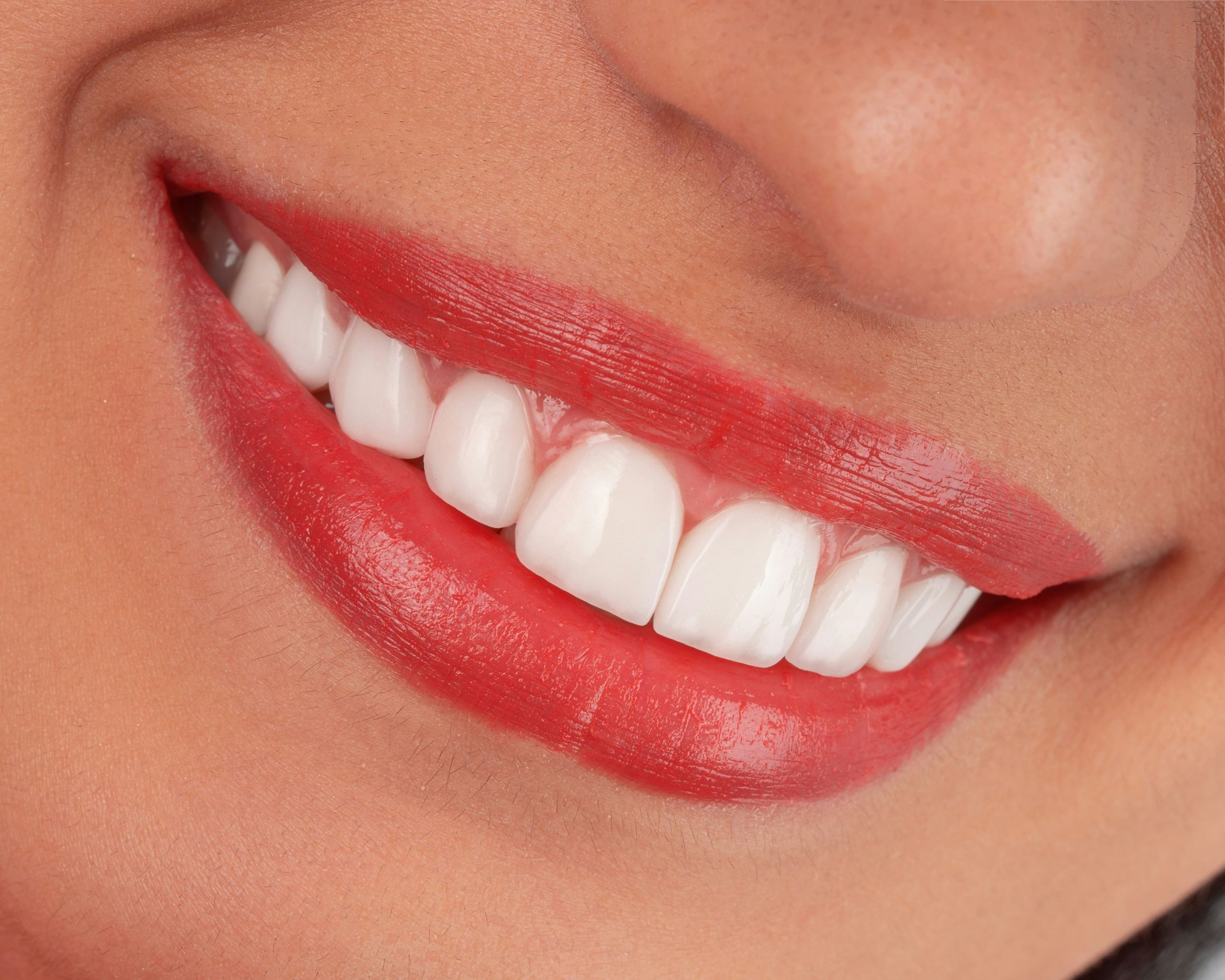 A close-up of a smiling person’s mouth, showing white teeth and lips with red lipstick—an impressive transformation after emergency root canal therapy.